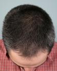 Before Hair Transplant&nbsp;Front